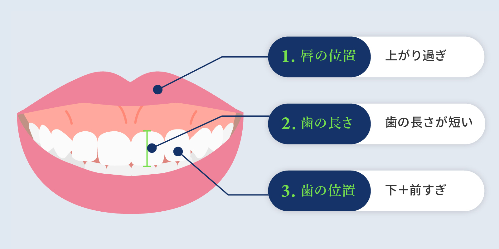 ガミースマイルの原因