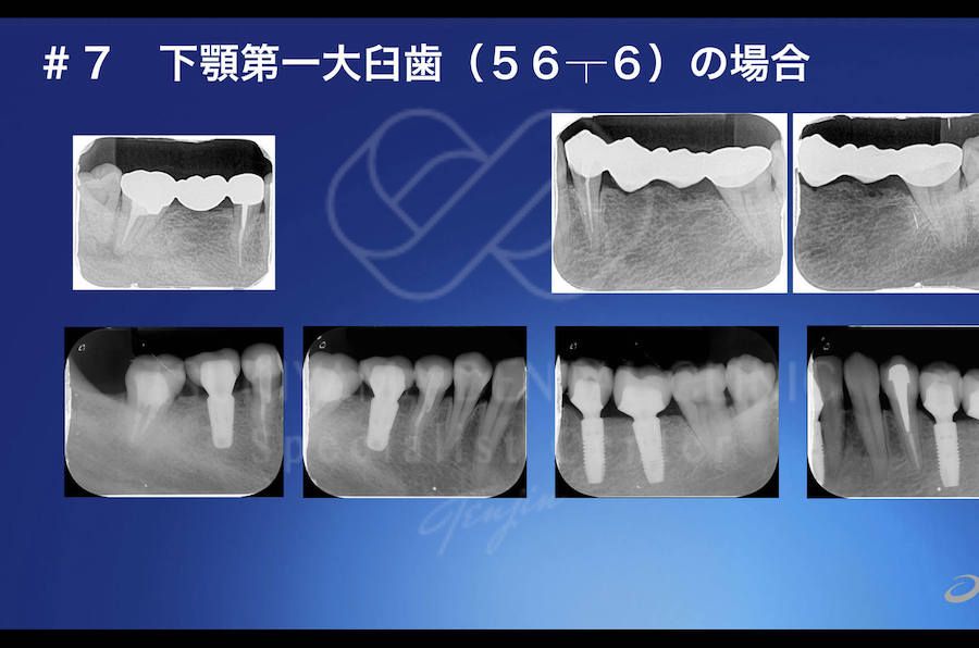 インプラント治療の症例写真｜下顎奥歯のブリッジと歯根が写る治療前と人工歯を支えるインプラントが写る治療後のレントゲン画像を並べた比較