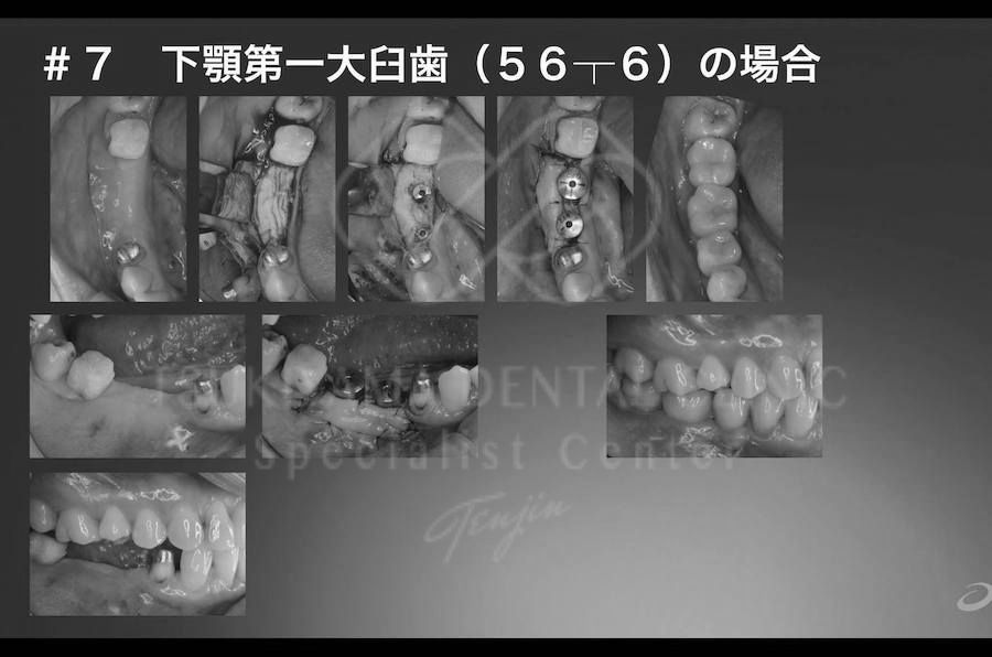 インプラント治療の症例写真｜下顎奥歯が欠損した治療前と歯ぐきを開いてインプラントや金属部品を装着する治療中および人工歯を装着した治療後の経過写真