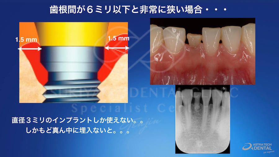 ガイデッドサージェリーによるインプラント治療の説明画像｜下顎前歯の口腔内写真とレントゲン画像および歯根間が6ミリ以下の狭い部位への埋入位置を示す模式図