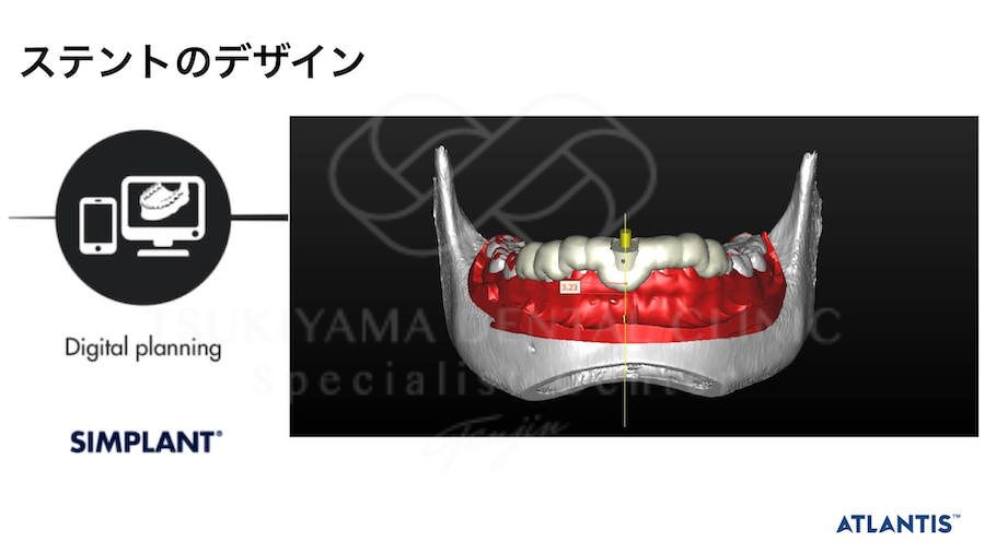 ガイデッドサージェリーによるインプラント治療の説明画像｜正面から見た下顎の3D画像上で前歯部の埋入位置に合わせて手術用ステントを設計するデジタル治療計画